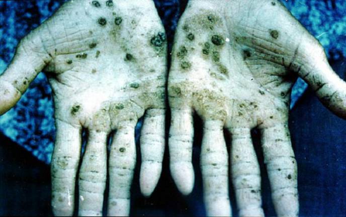Metal Poisoning