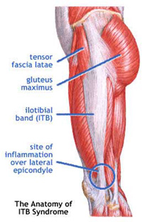 itbsyndrome